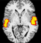 MRI-scan hersenen