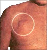 Pacemaker