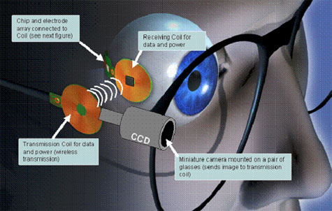 Retina-implantaat van MIT Retina-implantaat van MIT