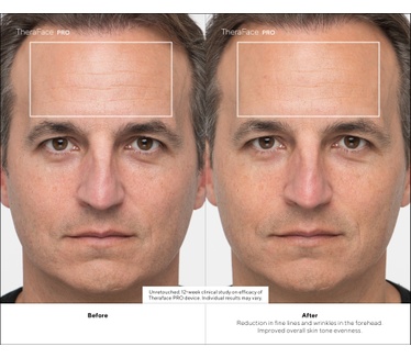 Therabody TheraFace PRO