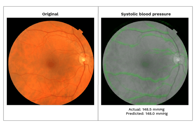 Google onderzoek retina